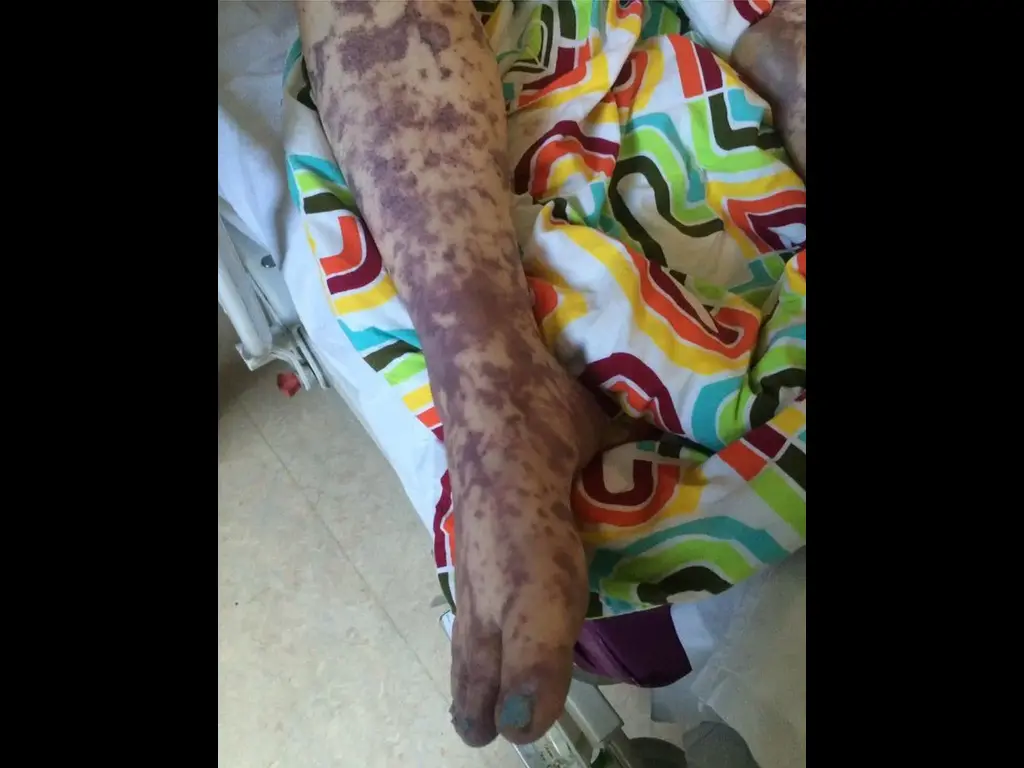 Meningococcal-1